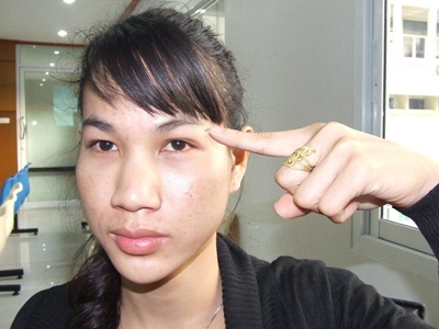 Nopparat Amphanan points to where two ladyboys gave him silicone injections that left him blind in one eye.